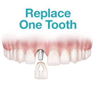 replace one tooth